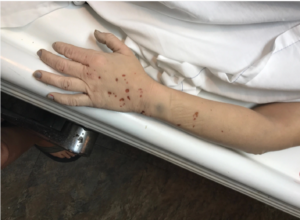 The markings found on her arm, the cause of these are still unknown.