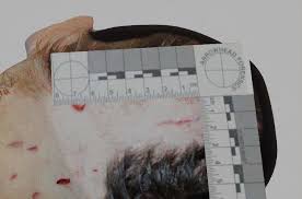 Head injuries of Ellen Greenberg